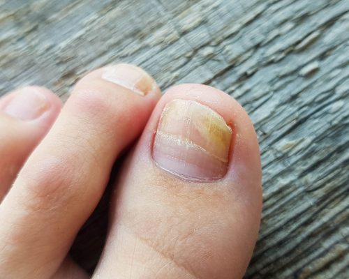 210707-The-Foot-Practice-Prevent-Toenail-Fugus