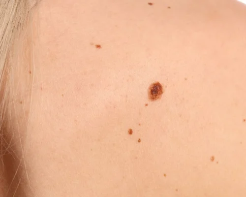 Skin-Lesion-Treatment